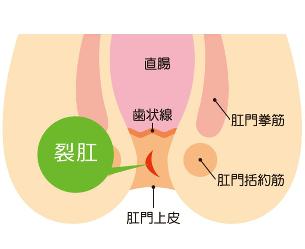 切れ痔（裂肛）