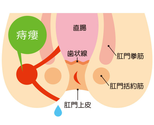 肛門周囲膿瘍