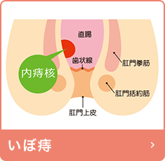 いぼ痔