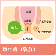 切れ痔（裂肛）