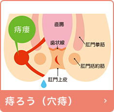 痔ろう（穴痔）