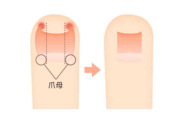 巻き爪・陥入爪の治療