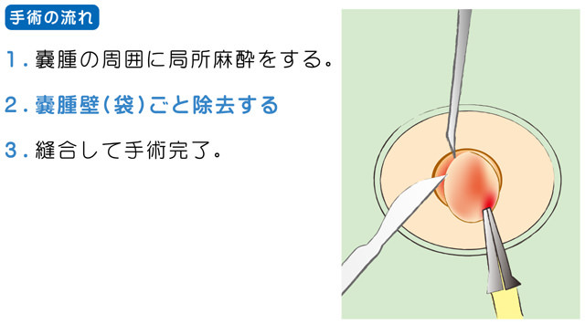 粉瘤の治療