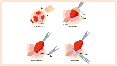 結紮切除手術