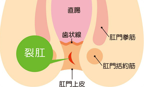 切れ痔（裂肛）