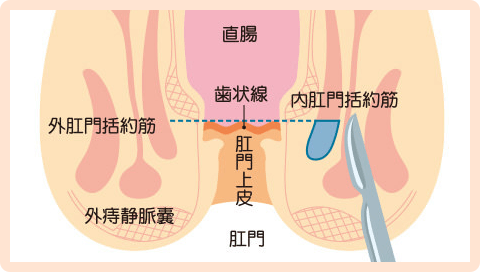 側方皮下内括約筋切開術