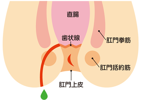 痔ろう（あな痔) 